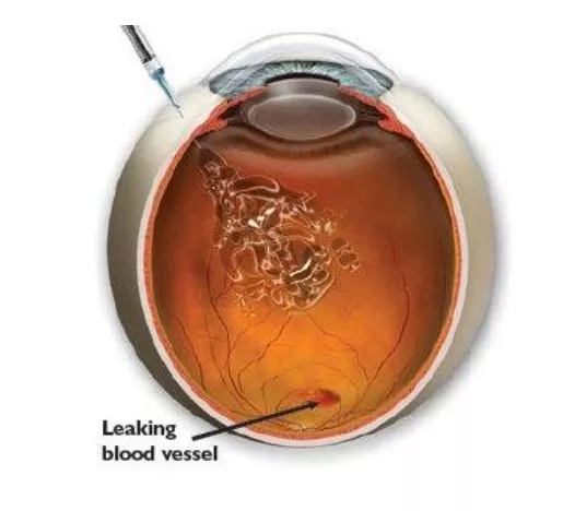 Post Intravitreal Injection Anjani Eye Hospital